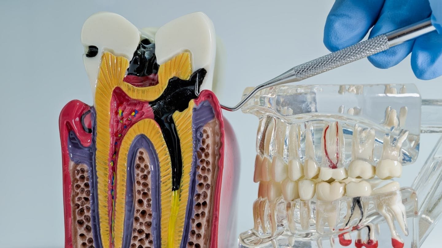 storitve endodontija