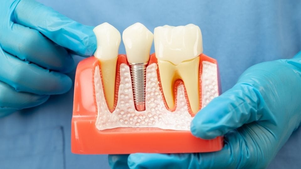 storitve implantantologija1