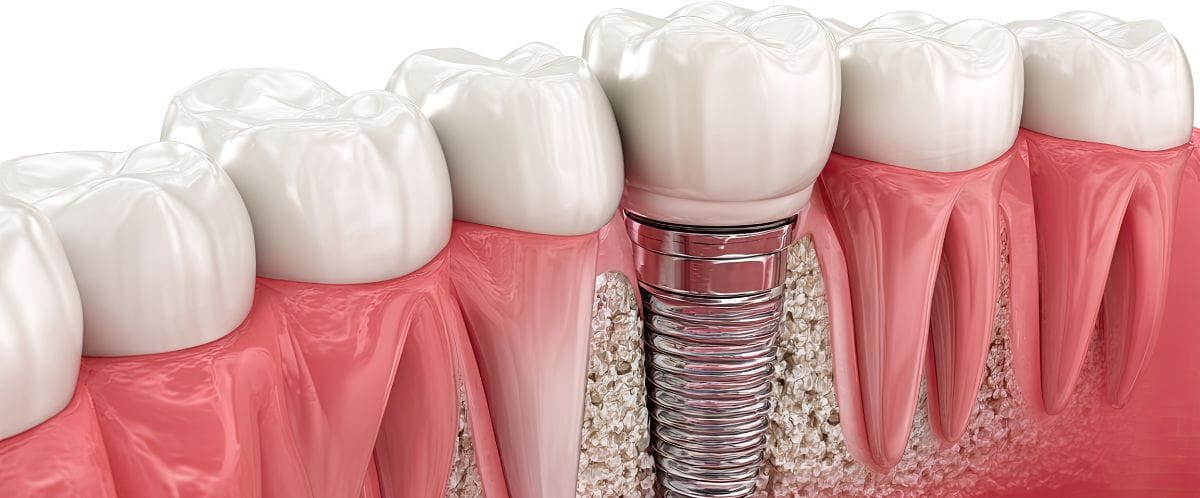 storitve implantantologija2