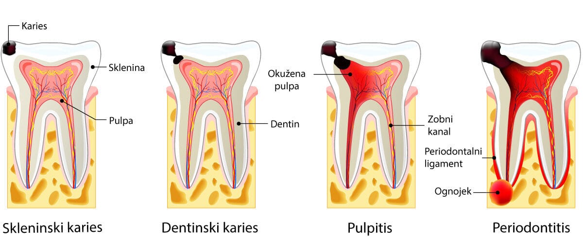 storitve sanacijakariesa2